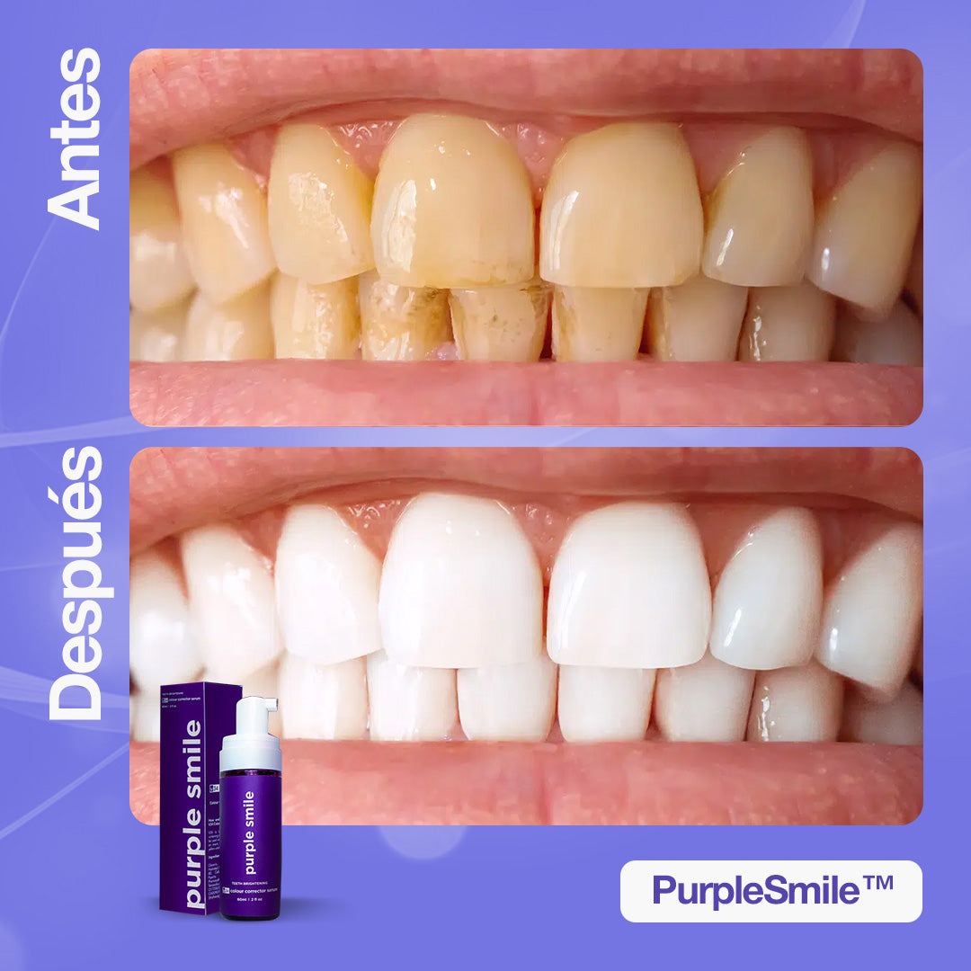 PurpleSmile™ | Di adiós a años de manchas y mal aliento