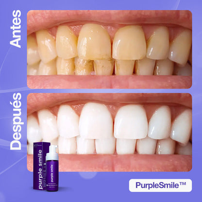 PurpleSmile™ | Di adiós a años de manchas y mal aliento